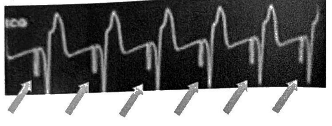 A QRS complex following every pacer spike, each spike arrowed.