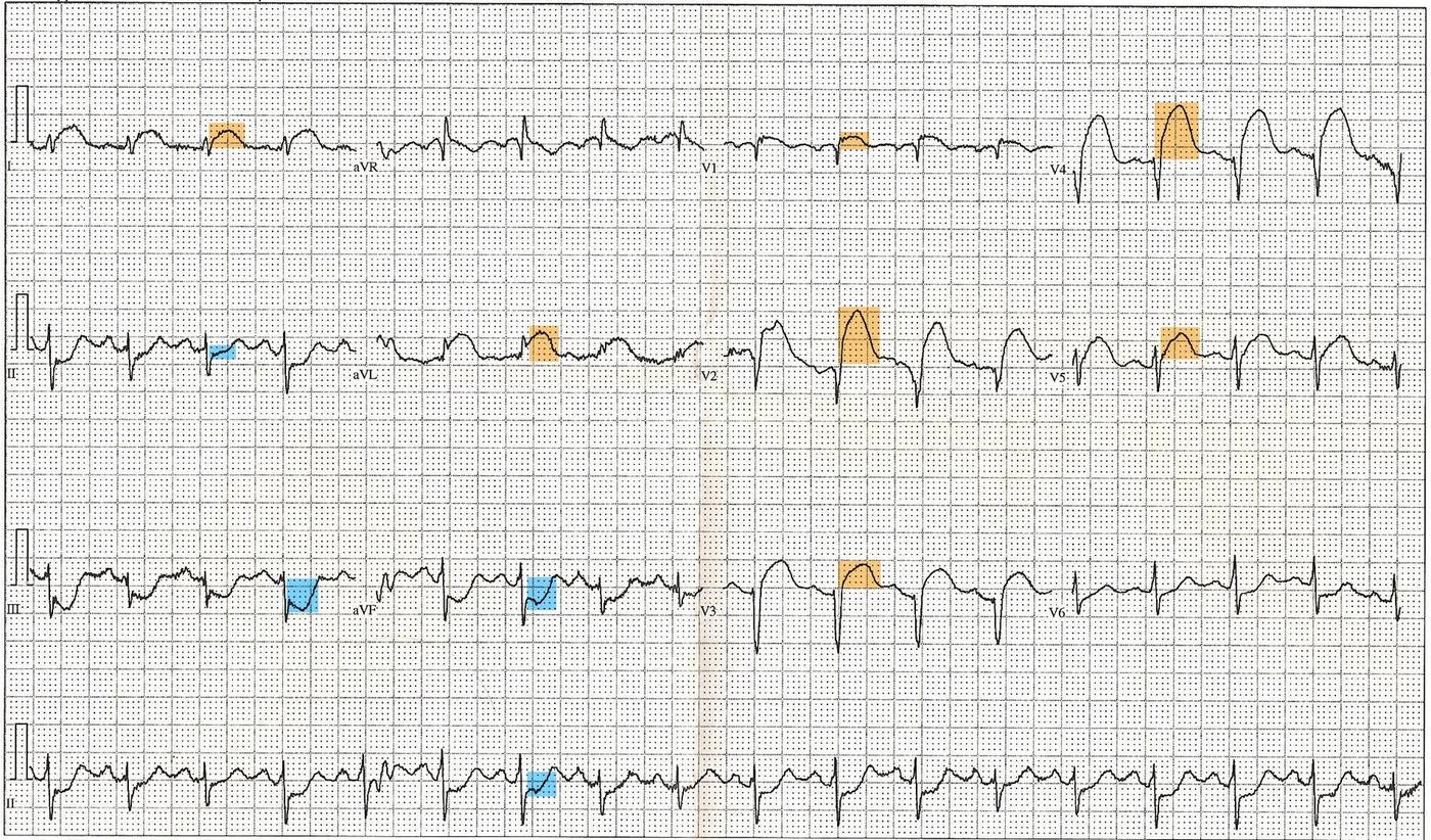 A 12-lead ECG with the elevated ST segments marked.