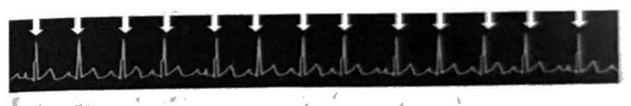 A rhythm strip with a sync marker sitting above each R wave.
